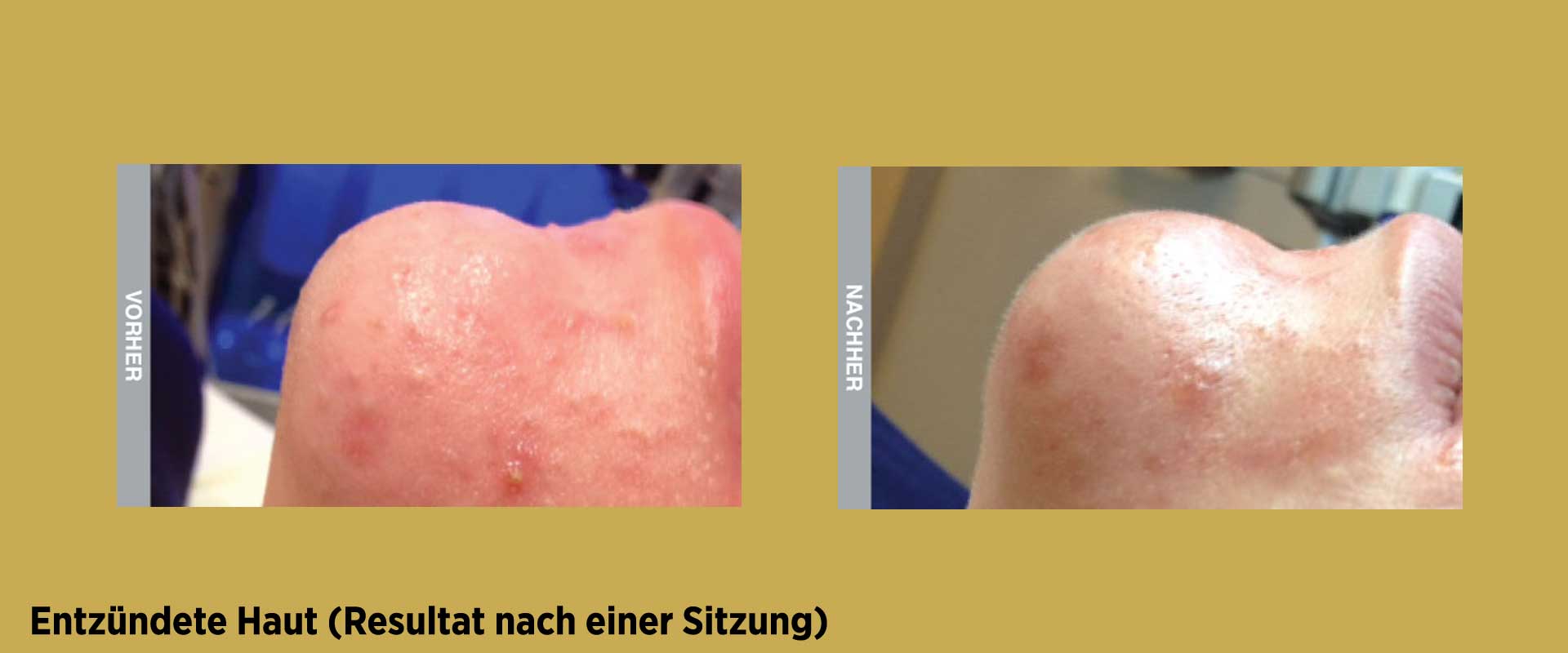 Vorher / Nachher Behandlung gegen entzündete Haut mit HydraFacial