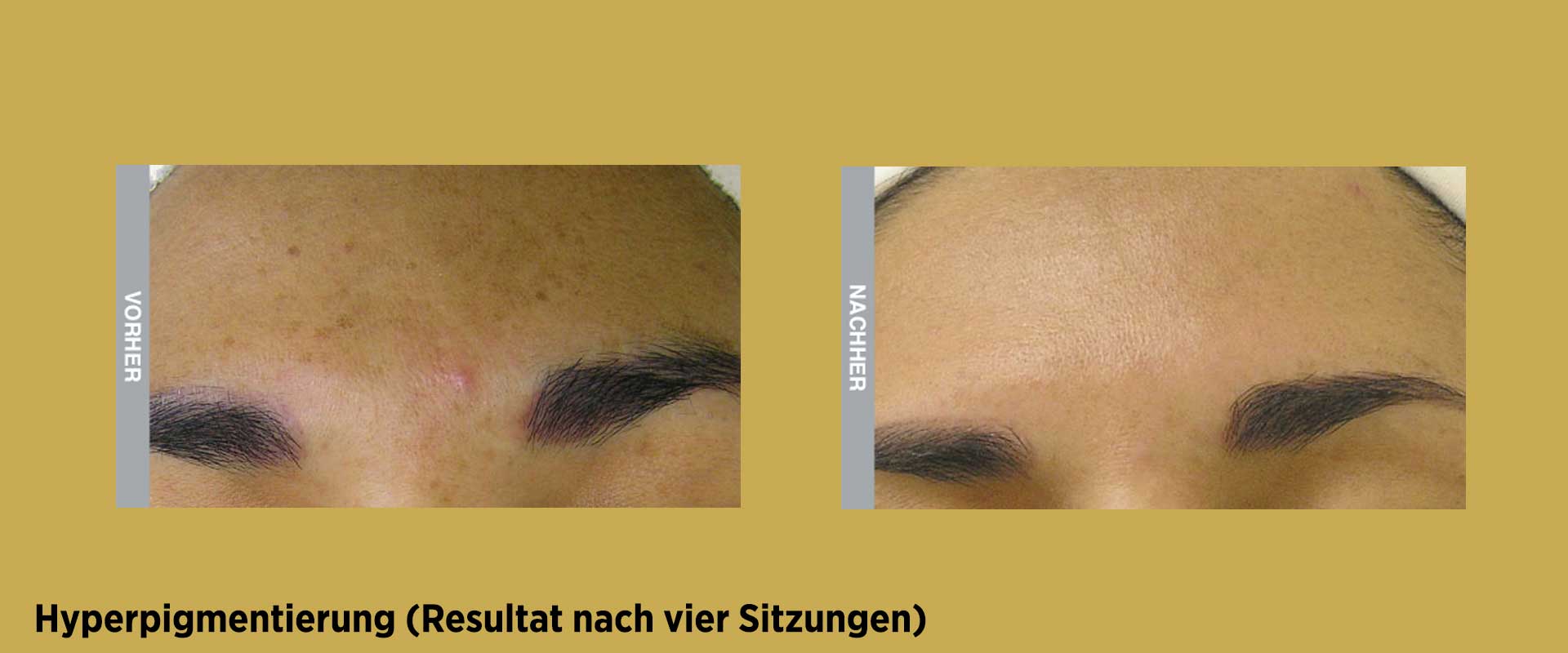 Vorher / Nachher Behandlung gegen Hyperpigmentierung mit HydraFacial
